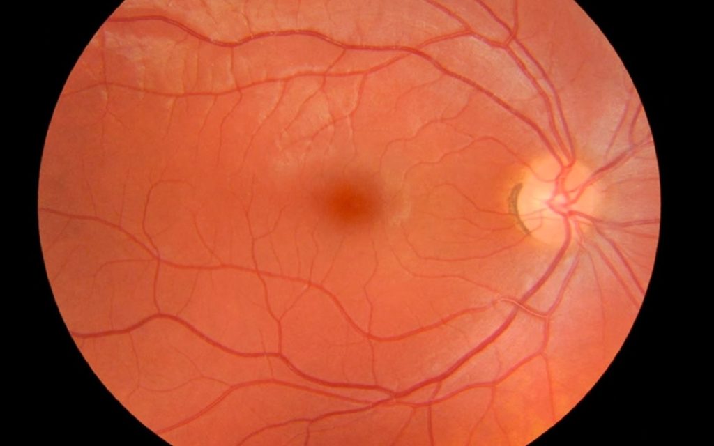 CIRURGIA DE CALÁZIO – Hospital de Olhos e Visão do Pará (HOVP)