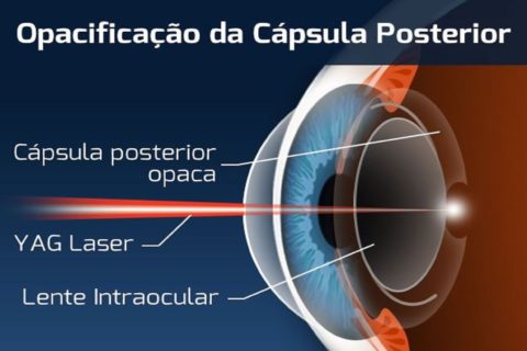 CIRURGIA DE CALÁZIO – Hospital de Olhos e Visão do Pará (HOVP)