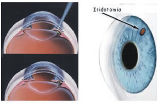 Iridotomia À Yag Laser Hospital De Olhos E Visão Do Pará Hovp