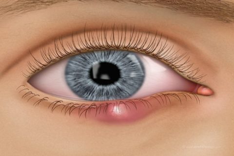 Você sabe a diferença entre terçol e calázio? – Hospital de Olhos