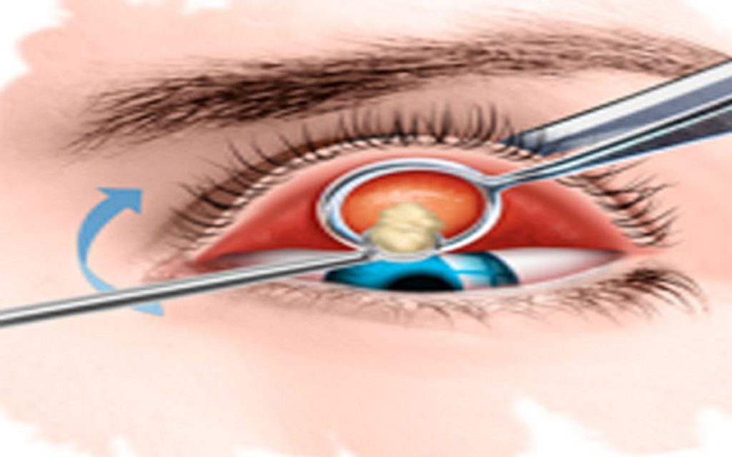 CIRURGIA DE CALÁZIO – Hospital de Olhos e Visão do Pará (HOVP)