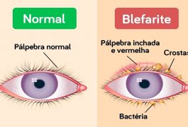 Pálpebra Normal x Blefarite